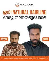 Xenofolix Hair Transplantation