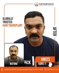 Xenofolix Hair Transplantation
