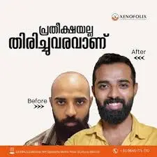 Xenofolix Hair Transplantation