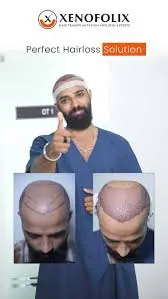 Xenofolix Hair Transplantation