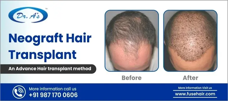 NeoGraft Clinic
